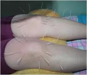 骨折后为什么要康复训练,什么是骨折后的康复治疗