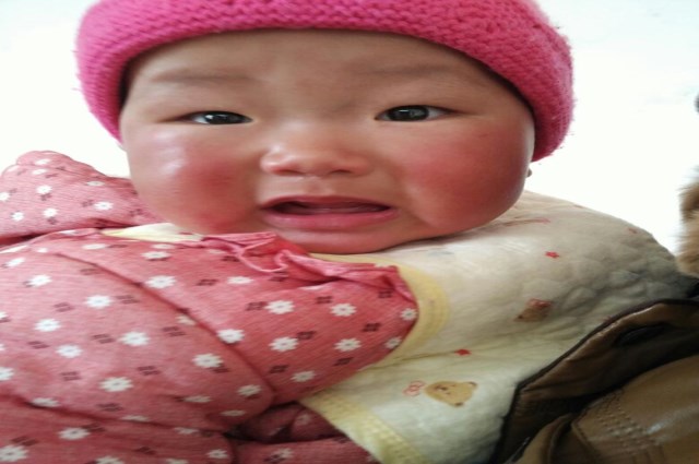 宝宝冬天手长冻疮,宝宝冻疮的原因及治疗方法