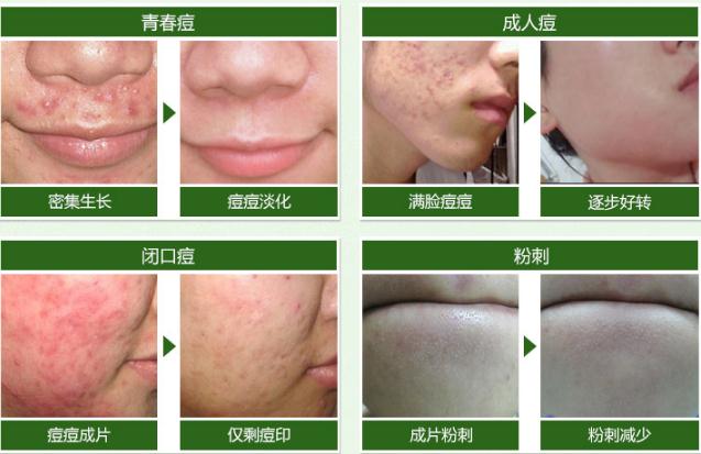 痘痘化脓了如何正确处理,红肿脓包型痘痘反复化脓用什么药