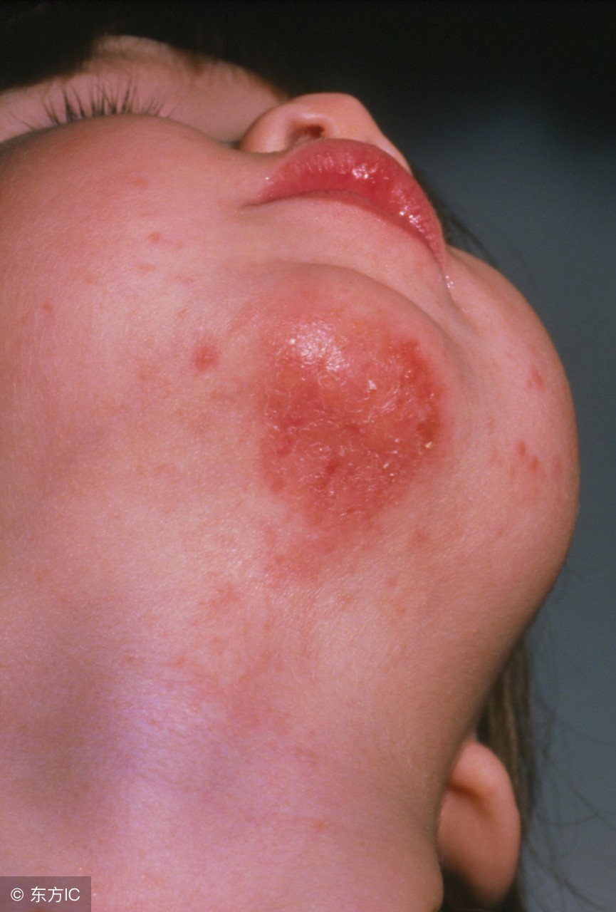 三岁宝宝湿疹一直反复怎么办,宝宝冬天长湿疹怎么处理