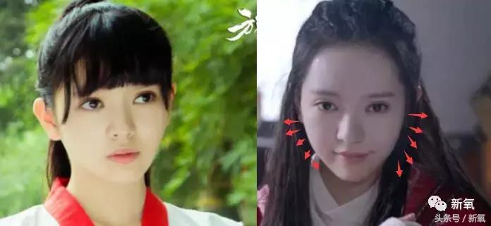 吴奇隆新剧搭档的女主13岁开始整形之路，这脸霹雳虎都hold不住！