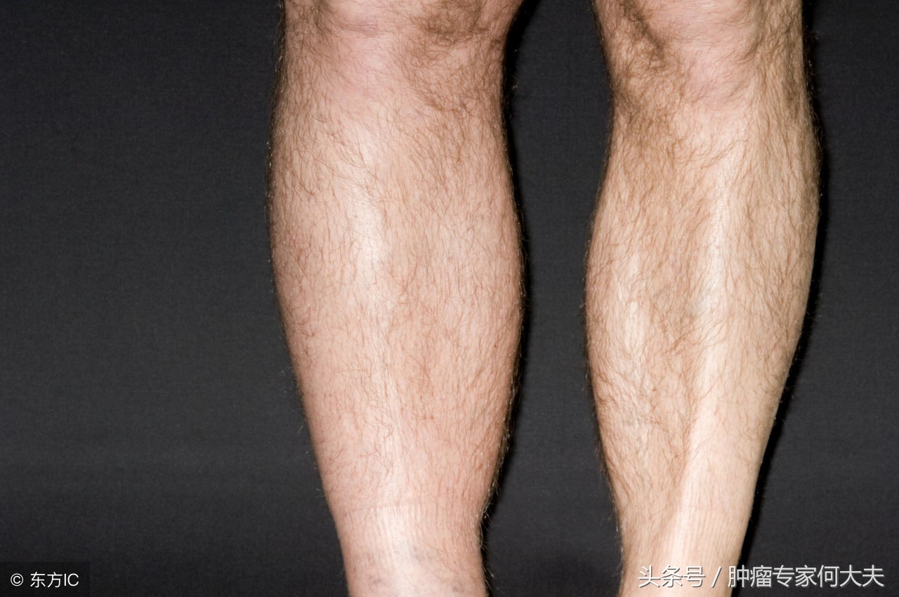 腿肿的厉害检查是肺癌,腿肿是肺癌的前兆吗