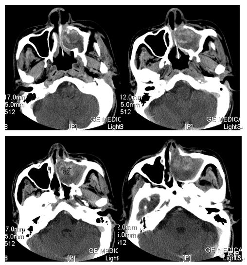 73岁患者无明显诱因出现左鼻塞、流脓涕，CT平扫发现密度影，怎么诊断？