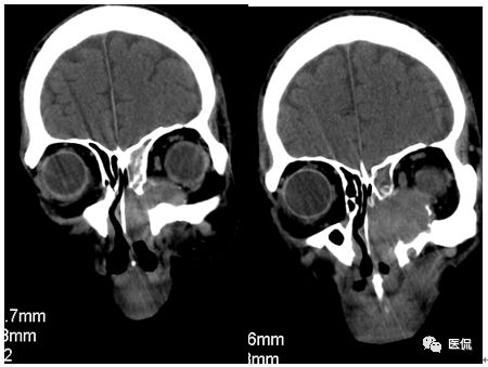 73岁患者无明显诱因出现左鼻塞、流脓涕，CT平扫发现密度影，怎么诊断？