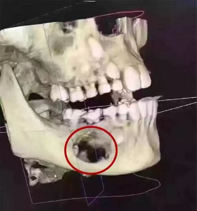 儿童乳牙坏了不拔可以吗,乳牙龋坏治疗