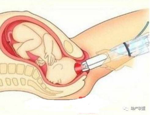 五种技巧让你轻松分娩,自然分娩接生技术