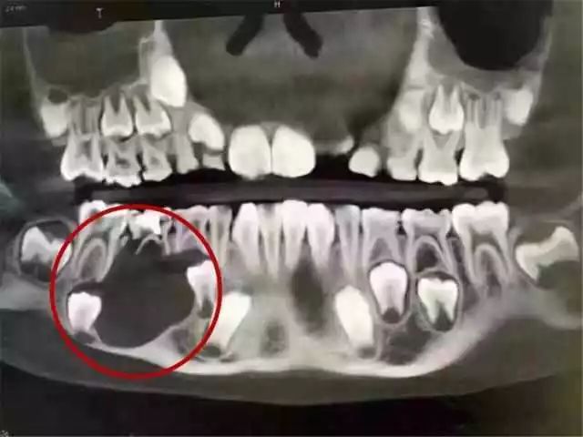 儿童乳牙坏了不拔可以吗,乳牙龋坏治疗