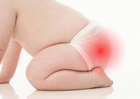 快速解决宝宝红屁股的方法,宝宝红屁股的民间办法