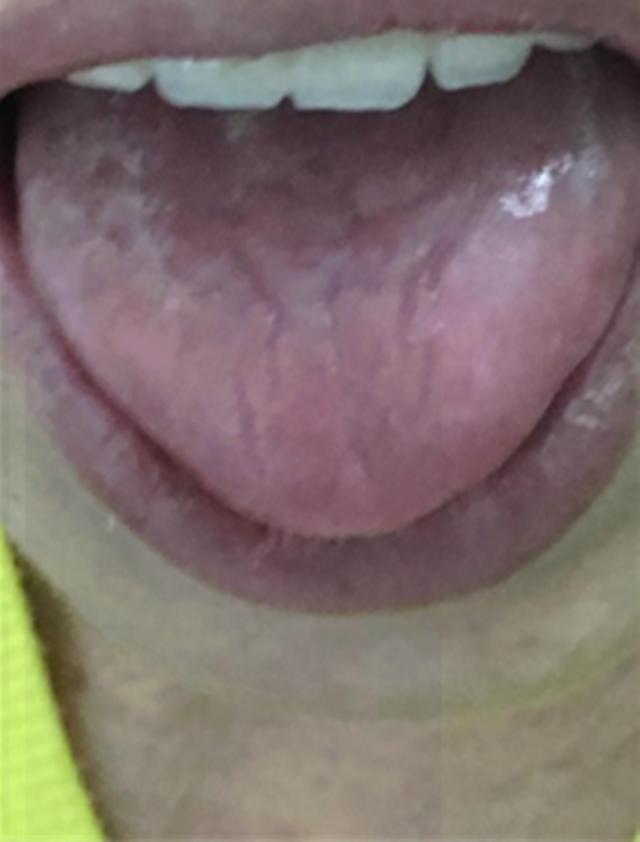 感冒咳嗽肺部感染中药配方,肺部感染中药经典处方医案