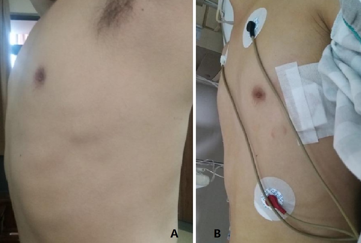 桶状胸手术,先天性桶状胸