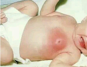 春节急诊，新生儿乳头红肿发炎！刚出生宝宝的乳头到底该不该挤？