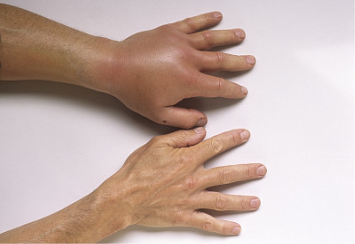 调补气血治疗功能性水肿