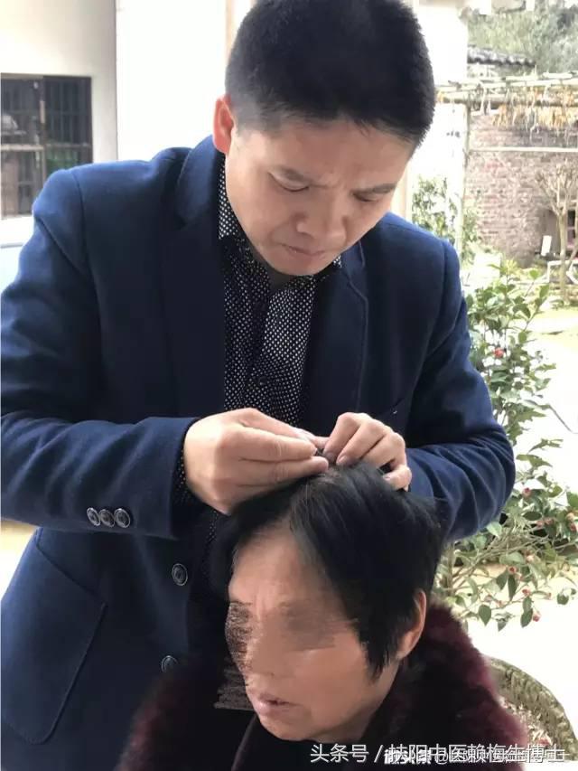 治疗带状疱疹用针灸和放血,带状疱疹内针治疗