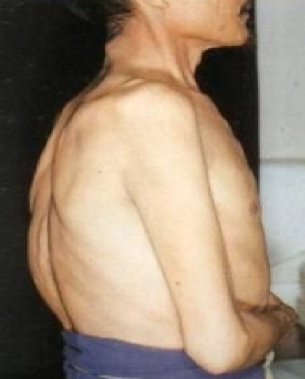 桶状胸手术,先天性桶状胸