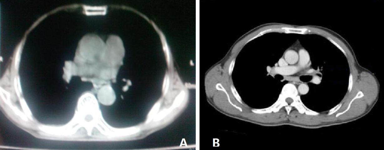 桶状胸手术,先天性桶状胸