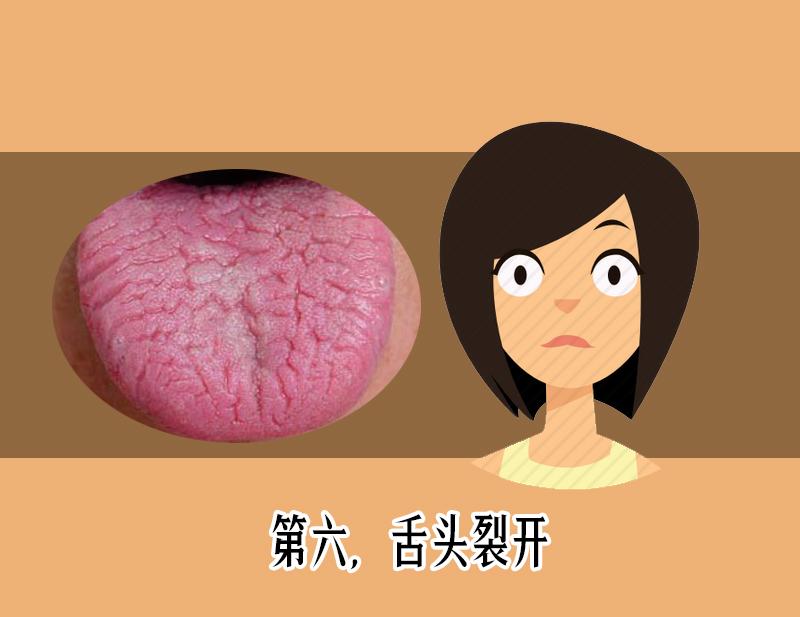 舌苔发黑辨证,舌苔整体发黄警惕四种原因