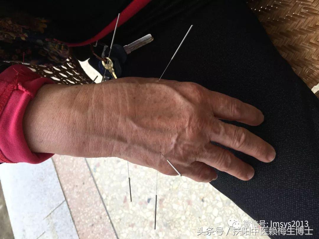 治疗带状疱疹用针灸和放血,带状疱疹内针治疗