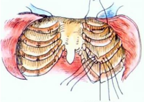 鸡胸超微创手术,鸡胸微创手术3d图