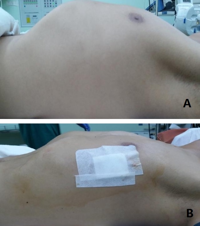桶状胸手术,先天性桶状胸