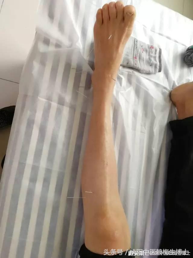 治疗带状疱疹用针灸和放血,带状疱疹内针治疗