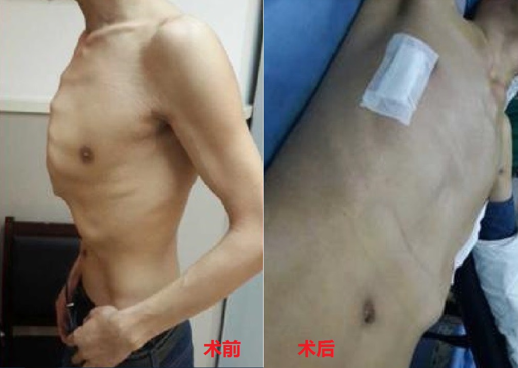 鸡胸超微创手术,鸡胸微创手术3d图