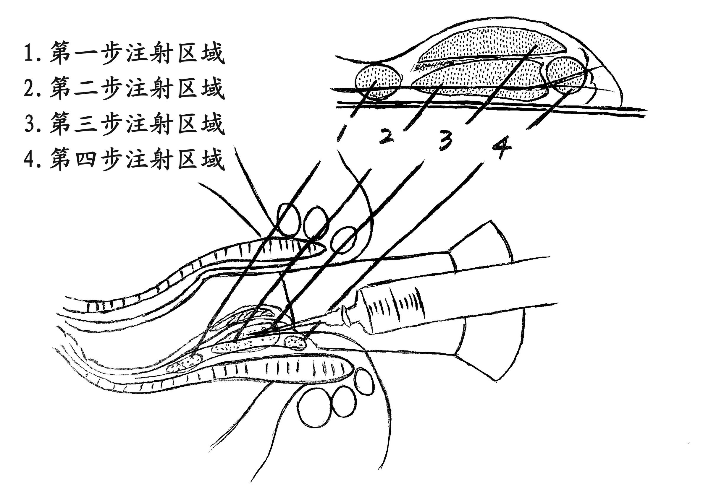 什么是中医枯痔疗法,枯痔疗法