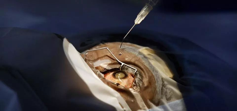 激光近视手术真的靠谱吗,激光近视手术靠谱吗