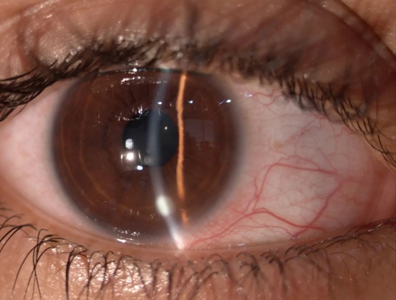 激光近视手术真的靠谱吗,激光近视手术靠谱吗