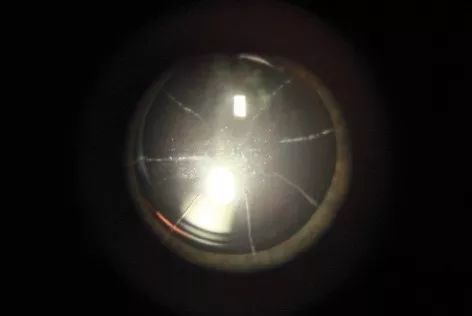 激光近视手术真的靠谱吗,激光近视手术靠谱吗