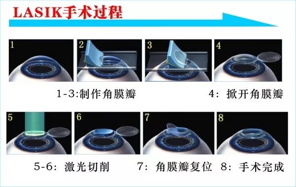 激光近视手术真的靠谱吗,激光近视手术靠谱吗