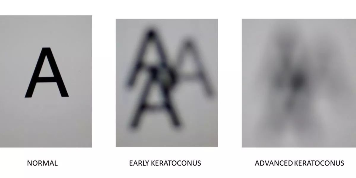 激光近视手术真的靠谱吗,激光近视手术靠谱吗