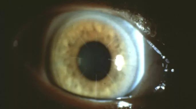 激光近视手术真的靠谱吗,激光近视手术靠谱吗