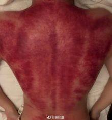 阿娇晒出刮痧照片，看第一眼以为是生牛肉！网友担心影响生孩子