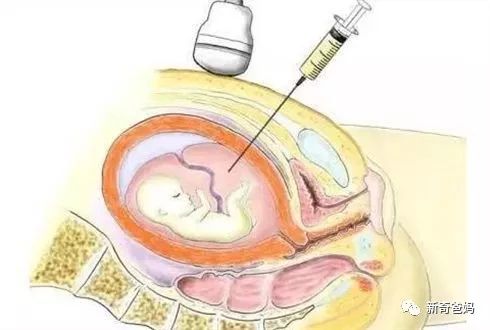 孕期羊水少怎么补,孕37周羊水少让住院