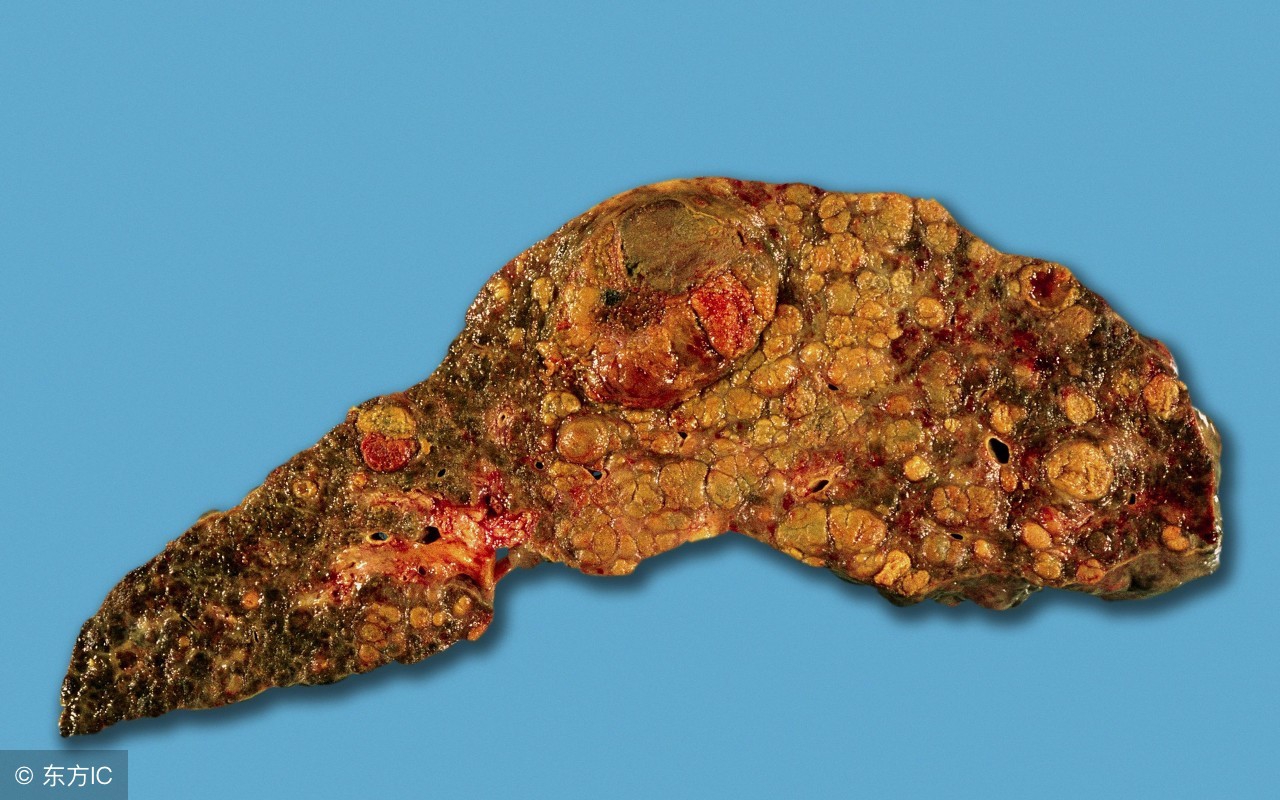 afp甲胎蛋白怀孕没升高,乙肝甲胎蛋白afp升高