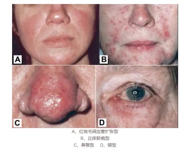 鼻子红红的酒糟鼻怎么护肤,鼻子两侧红血丝是酒渣鼻吗