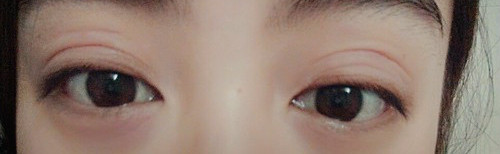 内双割双眼皮变成三眼皮怎么修复,双眼皮修复三次会有什么后果