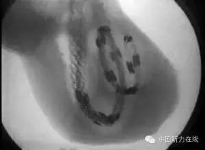 得了神经性耳鸣一定要坚持治疗,专治神经性耳鸣的偏方