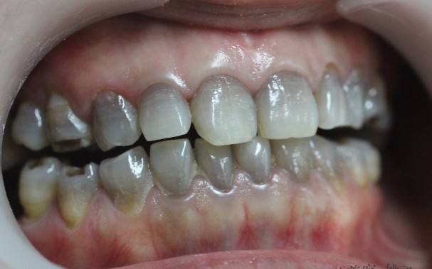 宝宝牙齿发黑是什么原因引起的,宝宝牙齿有点发黑是怎么回事