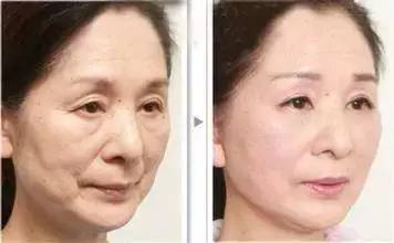 线雕是埋在哪个层次的,线雕埋进去能取出来吗