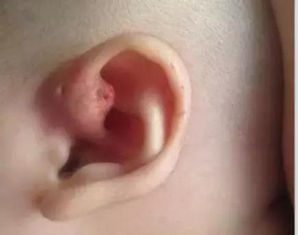 耳朵上方有个小孔流脓是怎么回事,耳朵的富贵洞能治好吗