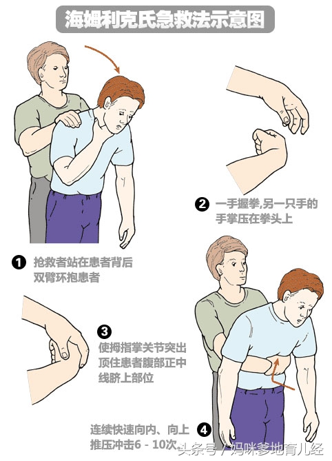儿童呛到气管急救措施视频,儿童气管呛入异物怎么取出