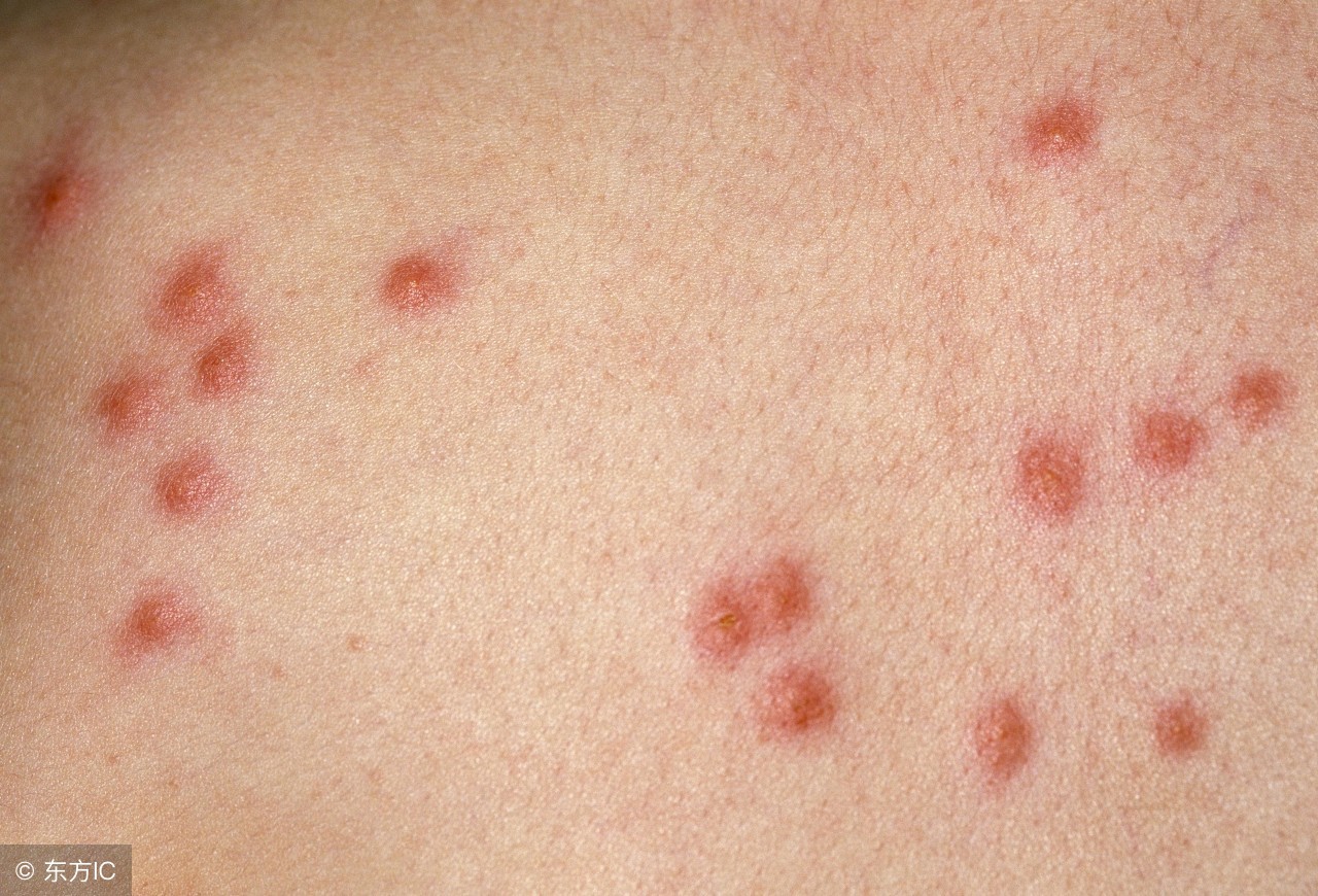 丘疹性荨麻疹症状是怎么引起的,丘疹性荨麻疹的症状与治疗方法
