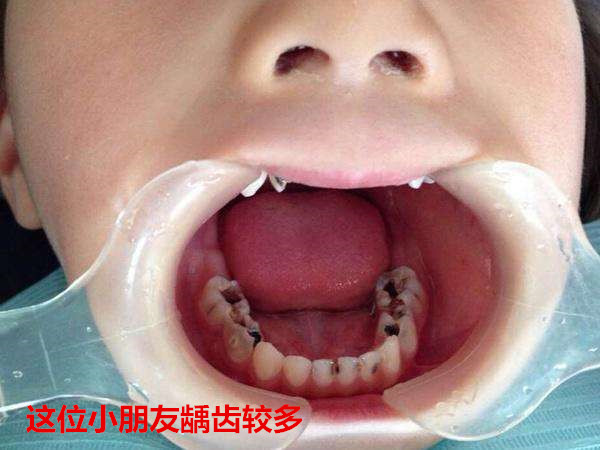 小孩牙疼一定不要轻易去治疗,家长们不可大意