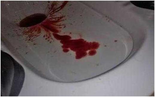 痔疮便血喷射怎么办,痔疮胀得很咋办