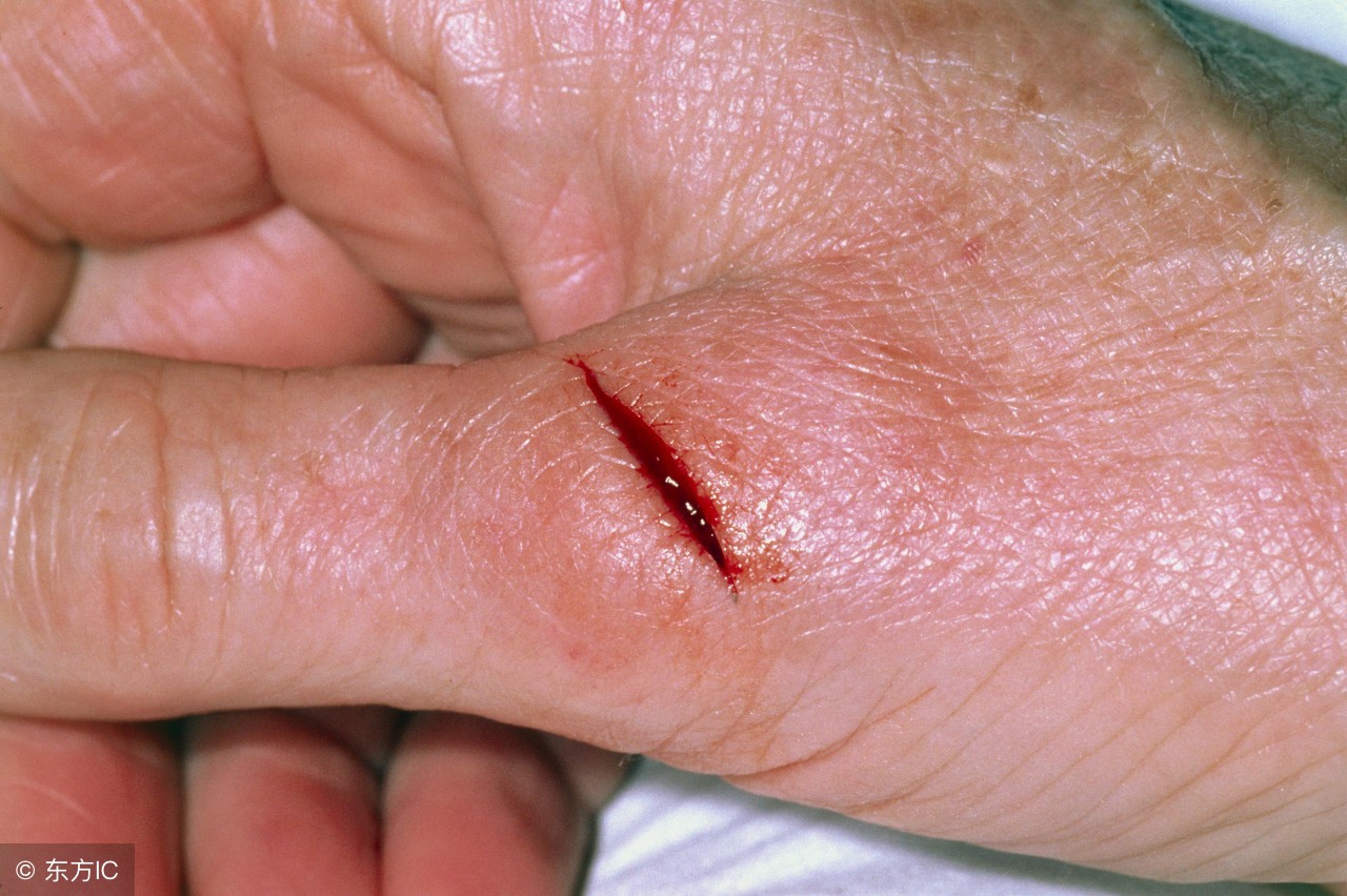 小刀划破手指要打破伤风吗,手被小刀划破了不停的流血怎么办