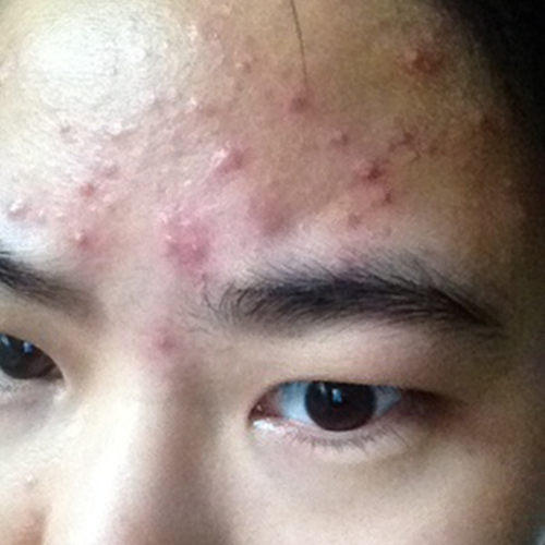 消灭痘痘的思路,到底要如何才能祛痘痘