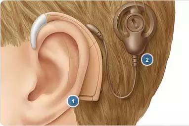 周知|为爱转发，泸州、宜宾贫困耳聋患儿可免费植入人工耳窩
