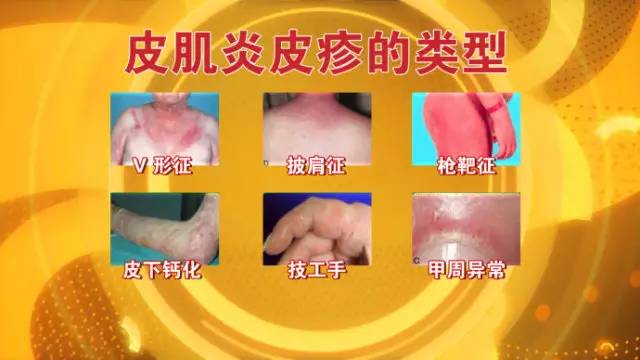 中日医院王国春教授,北京中日友好医院免疫科王国春