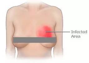 不用催奶师怎么下奶,乳腺炎请通乳师有用吗